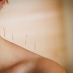 Young woman getting acupuncture treatment in therapy room