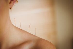 Young woman getting acupuncture treatment in therapy room